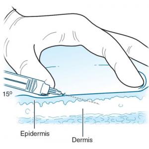 วิธีการฉีด เสต็มเซลล์ , เซลล์รกแกะ แบบต่าง ๆ