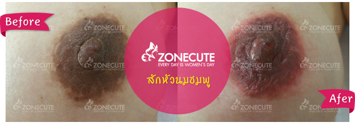 การสักหัวนมชมพู จะช่วยลดเรื่องปัญหาบุคคลที่มีสีหัวนมดำคล้ำได้อย่างดีมากเลย การให้บริการของร้านzonecuteอย่างเรา เน้นฝีมืออย่างมาก จึงทำให้ได้ผลงานหลังการสักหัวนมชมพูที่ดูดีอย่างเป็นธรรมชาติ ด้วยเทคนิคเฉพาะตัวที่ไม่สามารถหาได้จากที่อื่นแน่นอน และเรายังให้คำแนะนำทั้งก่อนและหลังของการสักนมอีกด้วยเช่นช่วงระยะเวลาที่สักหัวนมชมพูไปแล้วสีจะมีการลอกประมาณวันที่เท่าไหนและจะต้องใช้เวลากี่วันสีหัวนมถึงจะเริ่มเป็นหัวนมชมพู