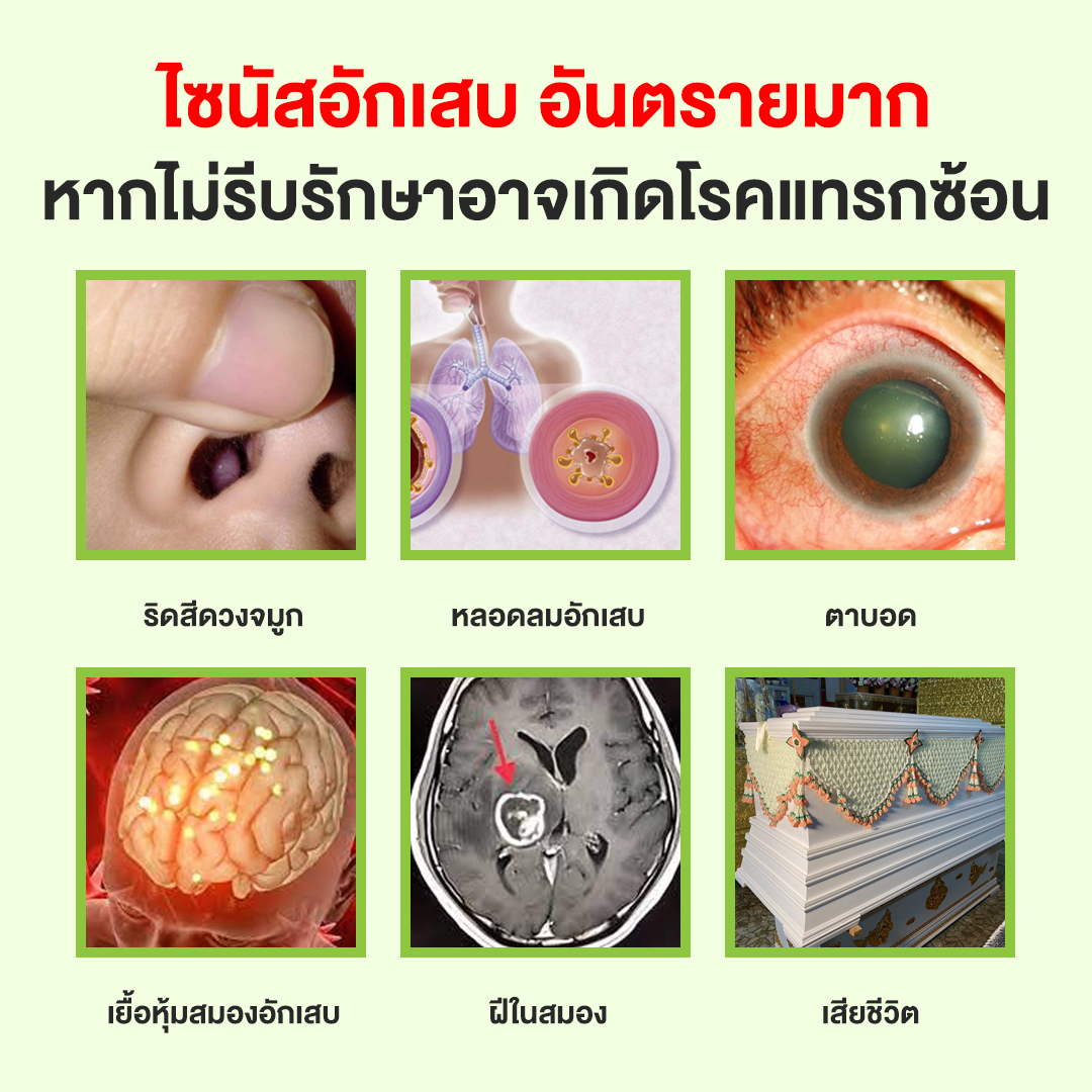 ไซนัสอักเสบ ไซนัสอักเสบ อันตรายหากไม่รับรักษาอาจเกิดโรคแทรกซ้อน