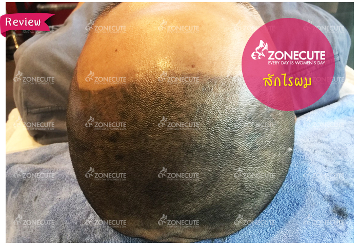 รีวิวการสักไรผมลูกค้าผู้ชาย ช่วยแก้ปัญหาหัวล้าน ไม่ให้เห็นหนังศีรษะ เพิ่มความมั่นใจกลับคืนมา