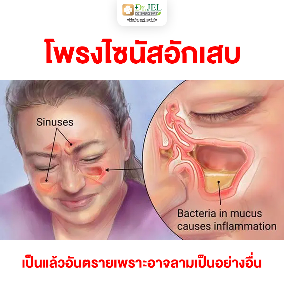 ไซนัสอักเสบ ไซนัสอักเสบ