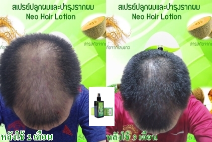 NeoHair นีโอแฮร์สเปรย์ สเปรย์ ผมยาว ผมร่วง ผมบาง ผมดกดำ