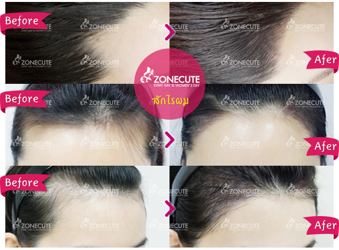 บริการสักไรผมอย่างมืออาชีพ ที่ร้านzonecuteได้นำเสนอผลงานมามากมายอย่างยาวนาน ซึ่งได้สะสมประสบการ์ผลงานรีวิวต่างๆกว่า22ปี จากที่เคยเป็นช่างประจำอยู่ที่ห้างเซ็นทรัล แล้วได้มาตั้งร้านเอง และได้คำนึงถึงราคาในการให้บริการ ที่เหมาะแก่ผู้ใช้บริการ แต่ผลงานฝีมือการสักไรผมยังคงเปี่ยมด้วยคุณภาพ การันตีความสวยและความกลมกลืนของเส้นผมได้อย่างมั่นใจ ทั้งยังเป็นการเพิ่มความมั้นใจในบุคลิคภาพภายนอกได้เป็นอย่างดี