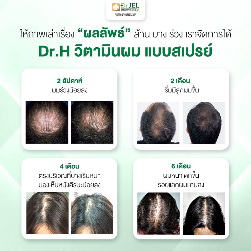 รีวิว เซรั่มปลูกผม ผมร่วง Dr.H