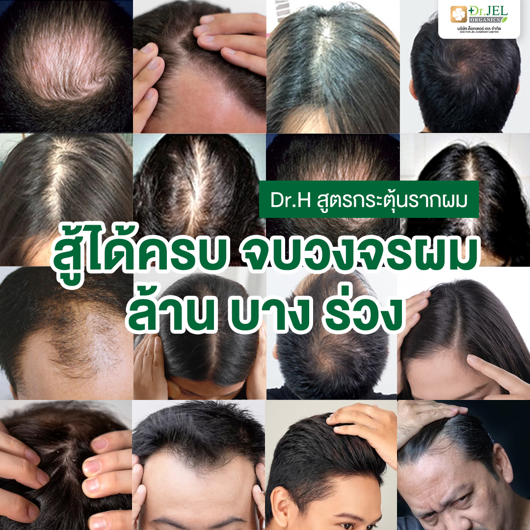 รีวิว เซรั่มปลูกผม Dr.H