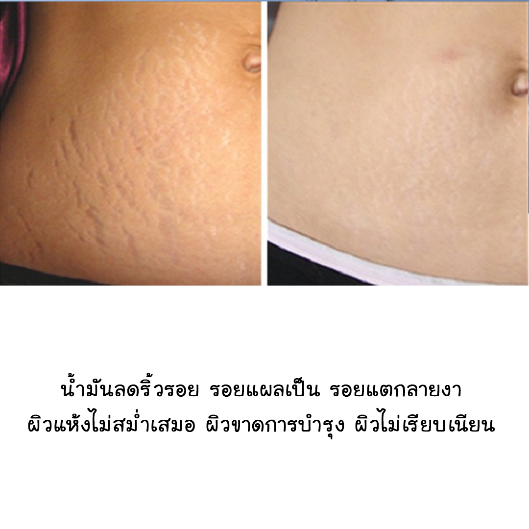 ✨ 12848 ชุดทำน้ำมันทาท้องแก้ท้องแตกลาย - สามารถผลิตได้ 1kg