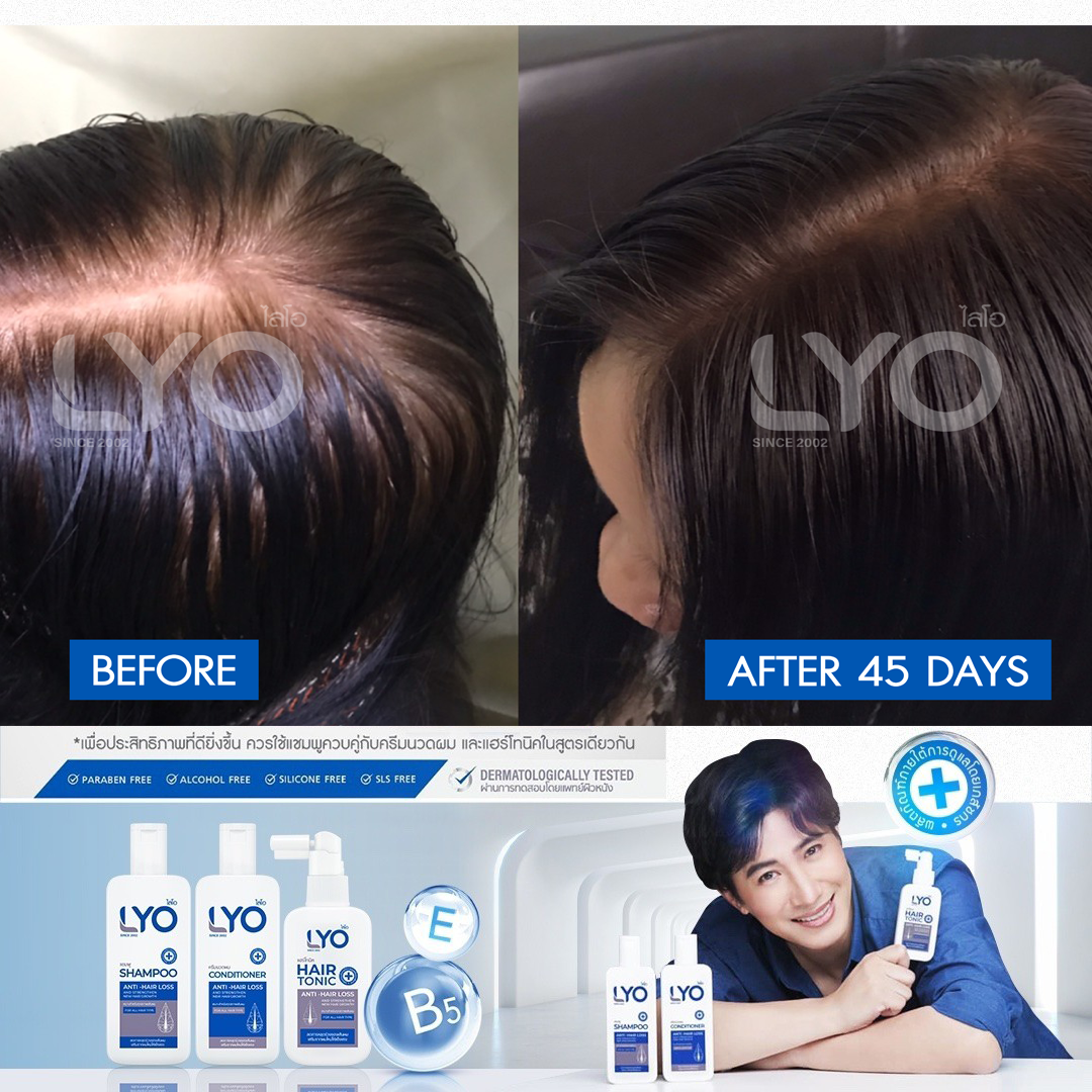 ไลโอ แชมพู 2 ขวด (LYO Shampoo) ผลิตภัณฑ์ทำความสะอาดเส้นผมและหนังศีรษะ