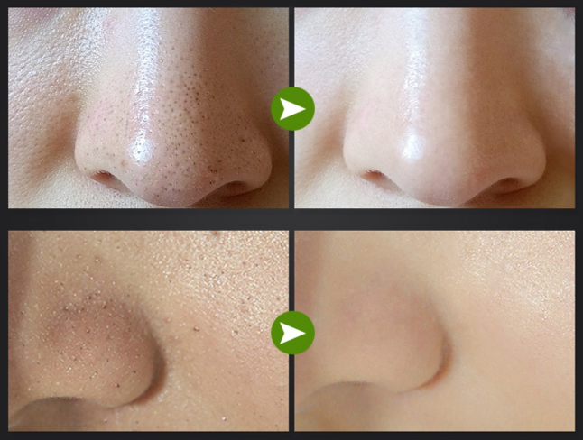 Yzkmskin Mark มาร์คลอกสิวเสี้ยวผงถ่านไม้ไผ่