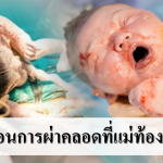 9ขั้นตอนการผ่าคลอดที่แม่ท้องอาจไม่รู้