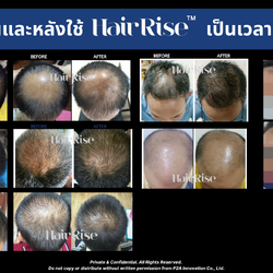 ตัวอย่างผลการใช้งาน Hair Rise ก่อนและหลัง