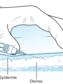 การฉีดยาโดยทั่วไปในการรักษาพยาบาล มี 4 วิธี